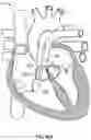 Fig. 46 - DEVICES AND SYSTEMS FOR DOCKING A HEART VALVE