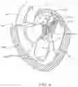 Fig. 06 - Methods and apparatus for engaging a valve prosthesis with tissue