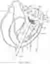Fig. 22 - Methods and apparatus for engaging a valve prosthesis with tissue