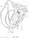 Fig. 33 - Methods and apparatus for engaging a valve prosthesis with tissue
