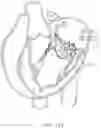 Fig. 40 - Methods and apparatus for engaging a valve prosthesis with tissue