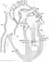 Fig. 01 - Percutaneous papillary muscle relocation