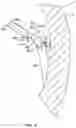 Fig. 06 - Percutaneous papillary muscle relocation