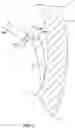 Fig. 08 - Percutaneous papillary muscle relocation