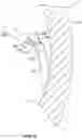 Fig. 09 - Percutaneous papillary muscle relocation