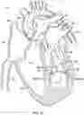 Fig. 22 - Percutaneous papillary muscle relocation