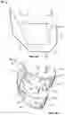 Fig. 03 - Variable thickness femoral augments