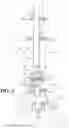 Fig. 04 - Ankle fusion system with expandable spacer