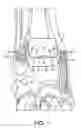 Fig. 02 - Stabilized total ankle prosthesis