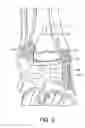 Fig. 04 - Stabilized total ankle prosthesis
