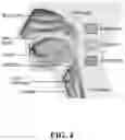 Fig. 06 - DEVICES, SYSTEMS, AND METHODS FOR TREATMENT OF SLEEP APNEA