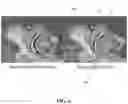 Fig. 08 - DEVICES, SYSTEMS, AND METHODS FOR TREATMENT OF SLEEP APNEA