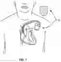 Fig. 02 - HEMOSTATIC DEVICES AND METHODS OF USE