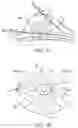 Fig. 02 - DEVICES AND METHODS FOR TISSUE TRANSFER