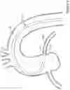 Fig. 02 - GUIDE EXTENSION CATHETERS AND METHODS FOR USING GUIDE   EXTENSION CATHETERS