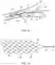 Fig. 07 - Medical device for sensing and or stimulating tissue