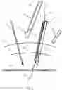 Fig. 02 - Systems, devices, and methods for closing an abdominal wall defect