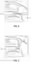Fig. 07 - Surgical constructs with shuttling loops and methods of tissue fixation