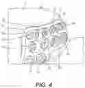 Fig. 06 - Bone stabilization systems