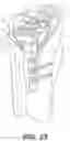 Fig. 28 - Bone stabilization systems