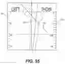 Fig. 50 - Bone stabilization systems