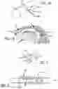Fig. 02 - Devices, systems and methods for treating benign prostatic hyperplasia and other conditions