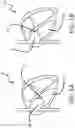Fig. 02 - Device for securing heart valve leaflets