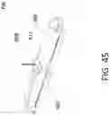 Fig. 49 - Device for securing heart valve leaflets