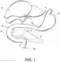 Fig. 02 - Intragastric device for treating obesity