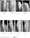 Fig. 02 - COMPOSITIONS AND METHODS FOR TREATING VARICOSE VEINS