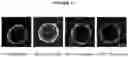 Fig. 09 - Method for the Treatment of a Solid Tumour