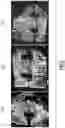 Fig. 06 - Phosphocalcic cement composition comprising blood
