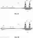 Fig. 06 - Dilation device and method of use