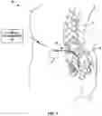 Fig. 02 - Cannula configured to deliver test stimulation