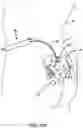 Fig. 12 - Cannula configured to deliver test stimulation