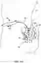 Fig. 14 - Cannula configured to deliver test stimulation