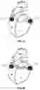 Fig. 04 - Method and device for atrial cardioversion therapy