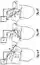 Fig. 08 - Method and device for atrial cardioversion therapy