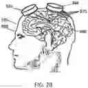 Fig. 04 - Radiosurgical neuromodulation close to critical structures