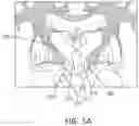 Fig. 07 - Radiosurgical neuromodulation close to critical structures