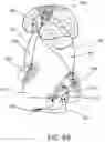 Fig. 10 - Radiosurgical neuromodulation close to critical structures
