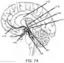 Fig. 11 - Radiosurgical neuromodulation close to critical structures