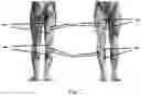 Fig. 05 - Interactive cycling system and method of using muscle signals to control cycling pattern stimulation intensity