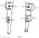 Fig. 15 - Interactive cycling system and method of using muscle signals to control cycling pattern stimulation intensity