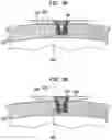 Fig. 07 - Convertibility of a bone conduction device