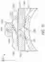Fig. 09 - SUTURE CLIP AND APPLIER TOOL