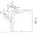 Fig. 13 - SUTURE CLIP AND APPLIER TOOL