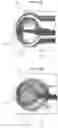 Fig. 14 - Aneurysm device and delivery system