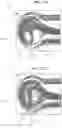 Fig. 16 - Aneurysm device and delivery system