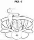 Fig. 06 - Methods and devices for spinal fixation element placement